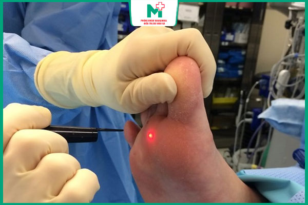 laser trị mụn cóc