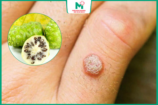 lưu ý trị mụn cóc trái nhàu