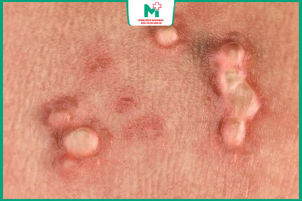 mụn cóc sinh dục lan rộng