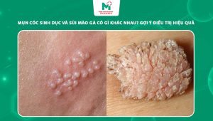 mụn cóc sinh dục và sùi mào gà