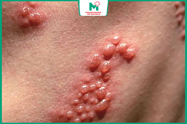 mụn cóc sinh dục