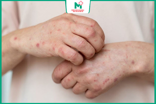 nữ giới bị giang mai