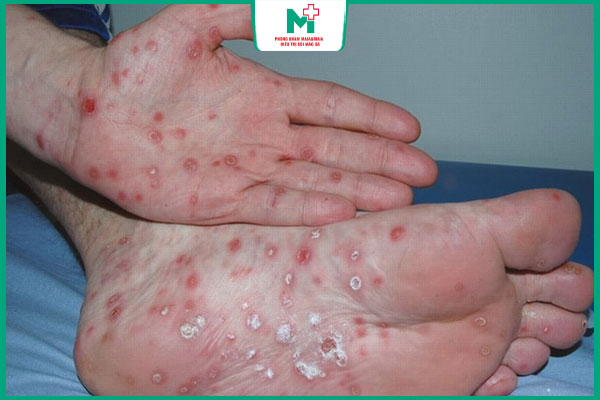 phát ban lòng ban chân