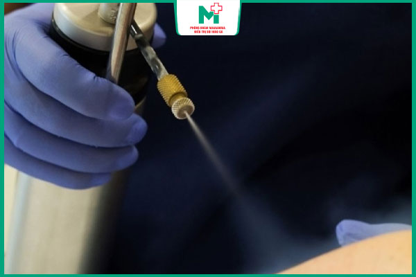 phun nitơ trị mụn cóc sinh dục