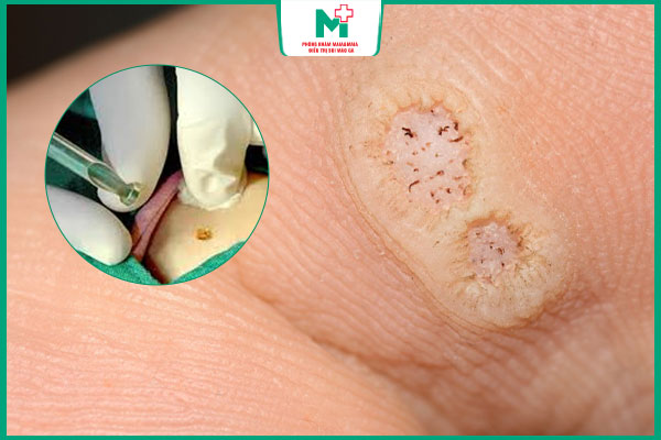 quy trình đốt laser trị mụn cóc