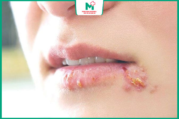 tổn thương giang mai ở miệng