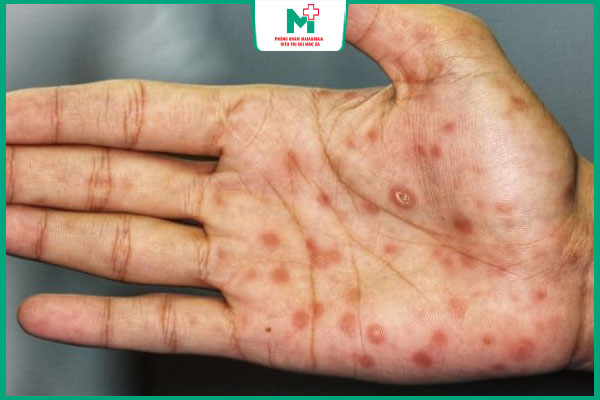 vết loét giang mai không ngứa