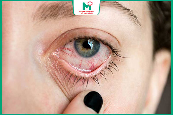 viêm màng bồ đào