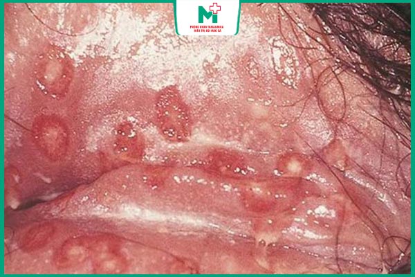 vùng kín có vết loét
