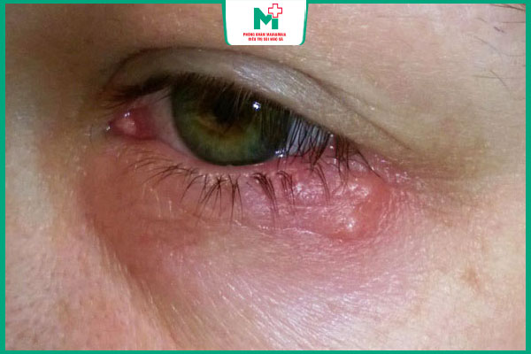 xoắn khuẩn tấn công mắt