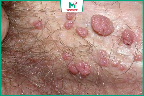 bệnh mụn cóc sinh dục ở nam giới