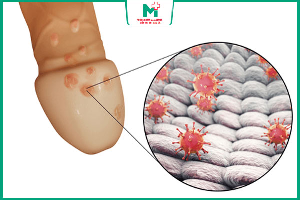 bệnh mụn cóc sinh dục ở nam