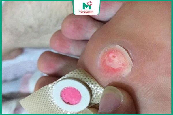 cách dùng băng dán mụn cóc