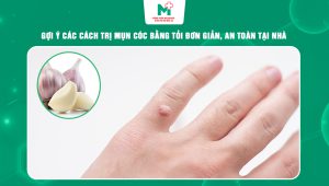 cách trị mụn cóc bằng tỏi