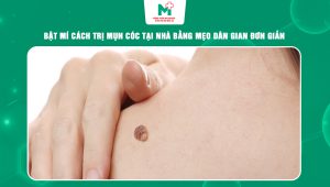 cách trị mụn cóc tại nhà