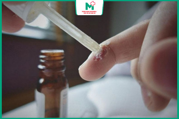 chấm salicylic acid lên mụn cóc