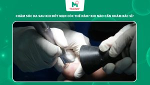 chăm sóc da sau khi đốt mụn cóc