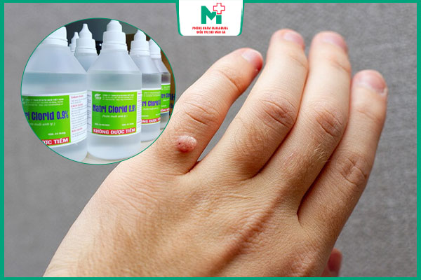 chăm sóc mụn cóc