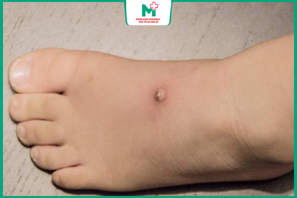 chân nổi mụn cóc