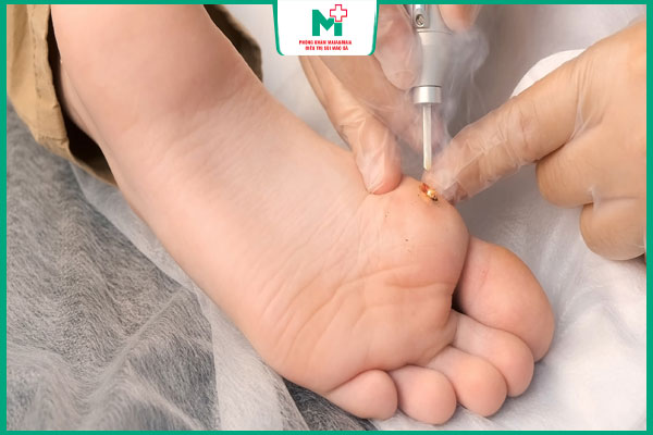 chi phí đốt mụn cóc bằng laser