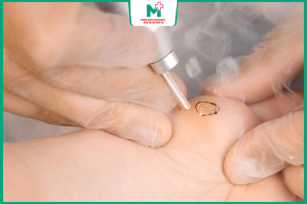 chi phí đốt mụn cóc