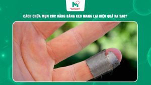 chữa mụn cóc bằng băng keo