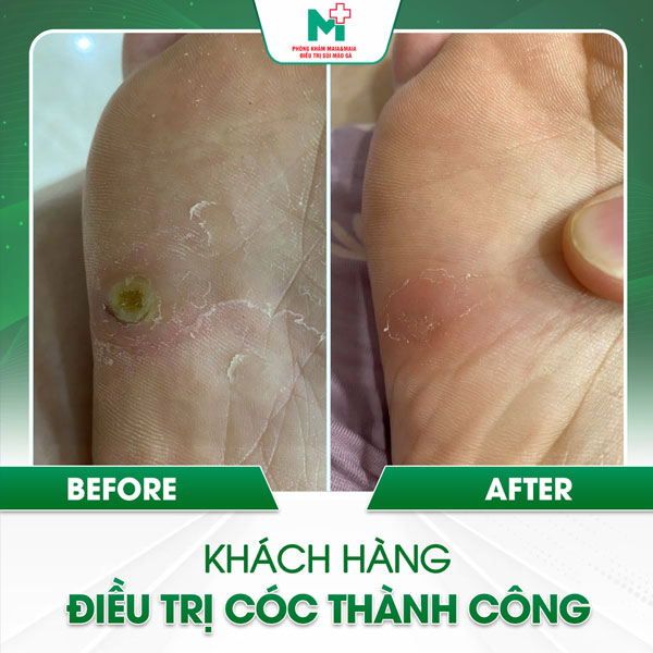 điều trị mụn cóc tại maia