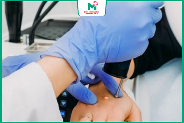 đốt điện loại bỏ mụn cóc