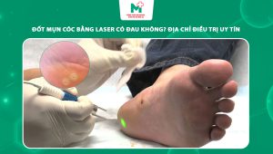 đốt mụn cóc bằng laser có đau không