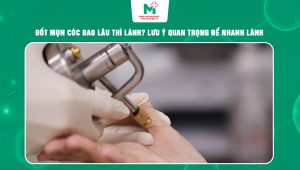 đốt mụn cóc bao lâu thì lành