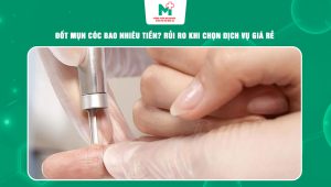 đốt mụn cóc bao nhiêu tiền