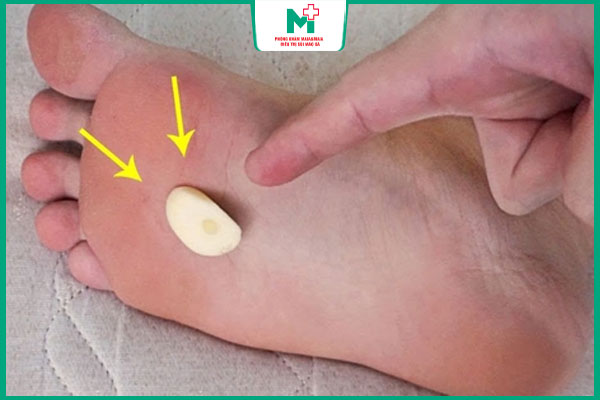 hiệu quả dùng tỏi loại bỏ mụn cóc