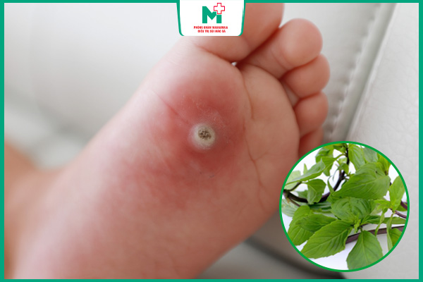 hiệu quả trị mụn cóc bằng húng quế