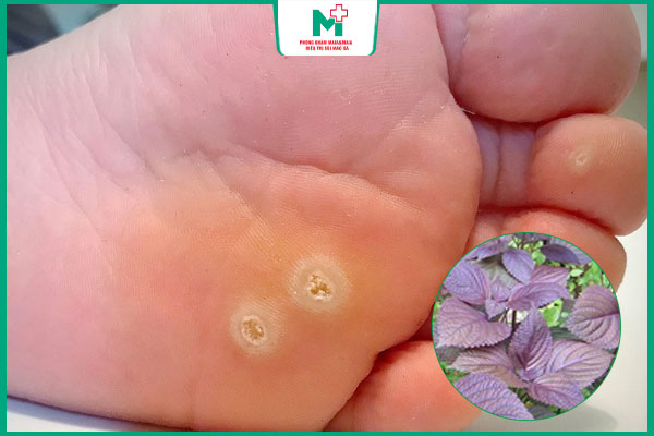 hiệu quả trị mụn cóc bằng lá tía tô