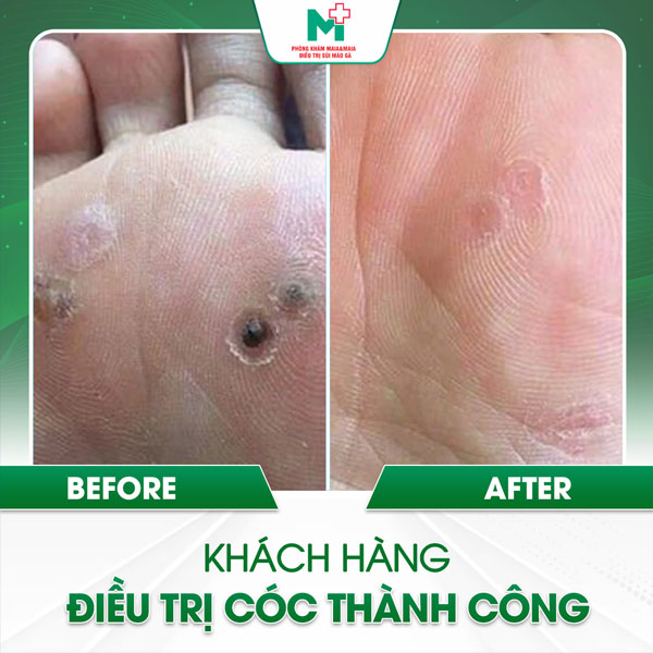 khách điều trị mụn cóc thành công