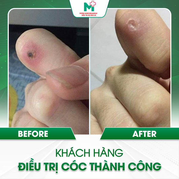 khách hàng trị mụn cóc tại maia