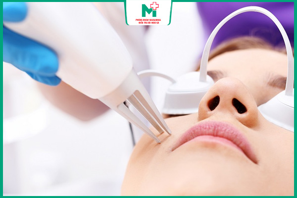laser trị mụn cóc mặt