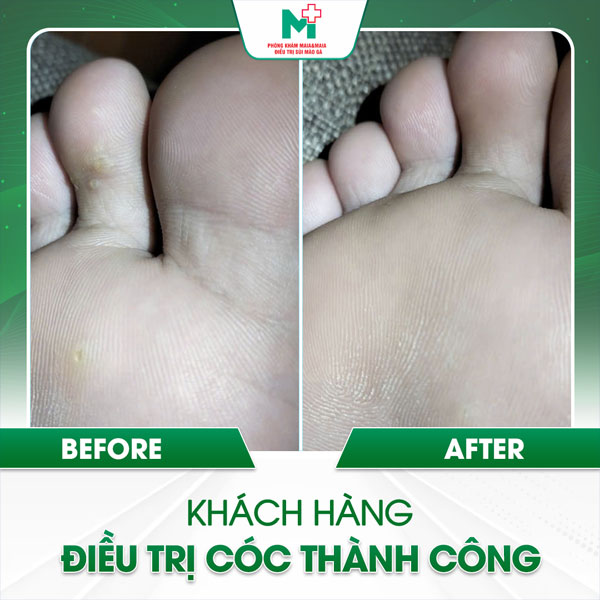 maia trị mụn cóc