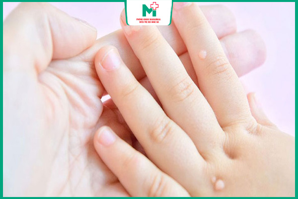 mẹo dân gian trị mụn cóc