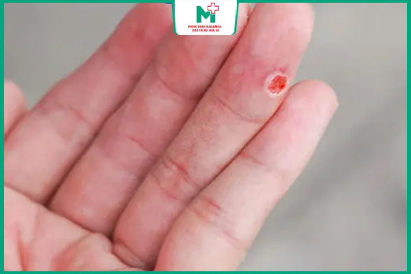 mụn cóc bị viêm