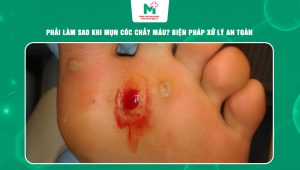mụn cóc chảy máu