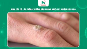 mụn cóc có lây không