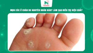 mụn cóc ở chân