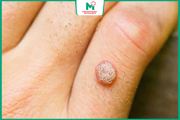 mụn cóc ở tay dễ rụng