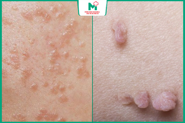 mụn cóc phẳng và u nhú