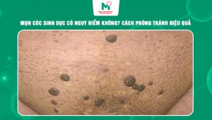 mụn cóc sinh dục có nguy hiểm không