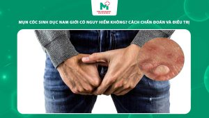 mụn cóc sinh dục nam giới