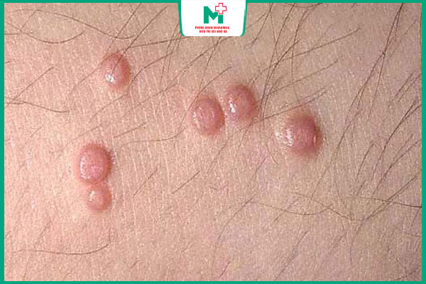 mụn cóc sinh dục vẫn có con