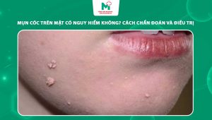 mụn cóc trên mặt