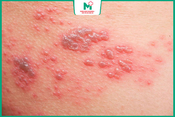 mụn rộp bị loét